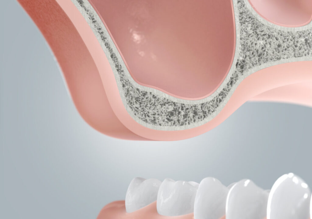 Dental implant bone augmentation before implantation